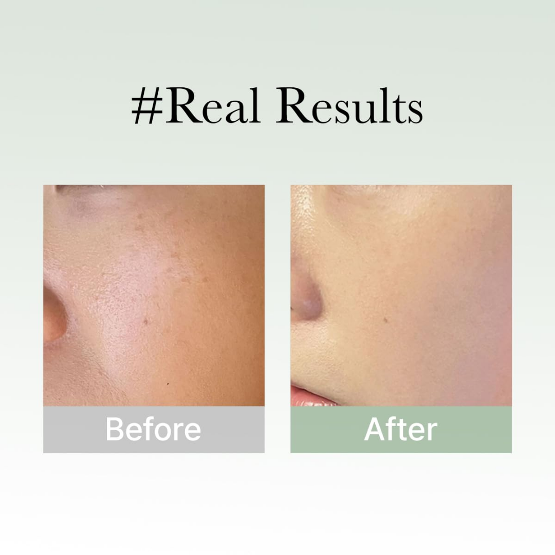 Arencia Holy Hyssop Serum - Remove Acne & dark sposts in 7 days