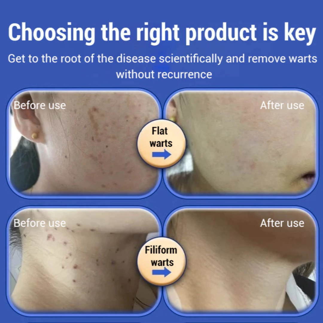 Acne & Acne Scars Removal Cream – Fast Acne Treatment, Fades Scars, Controls Oil & Bacteria – Suitable for Face, Back & Neck