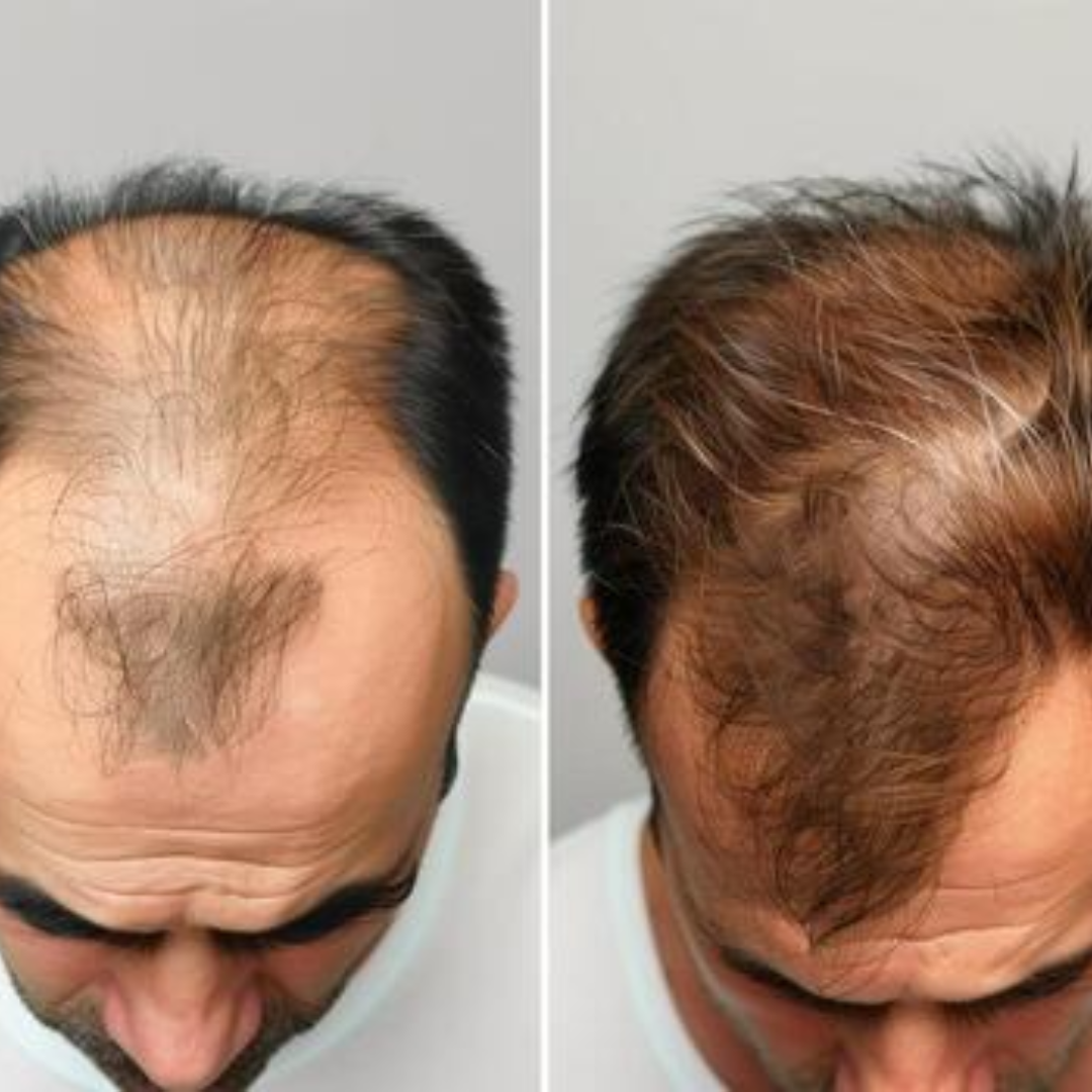 Proskire Hair Growth Serum – Reduces Hair Fall, Boosts Hair Density, Activates Follicles – For Bald Patches, Receding Hairline & Thinning Hair