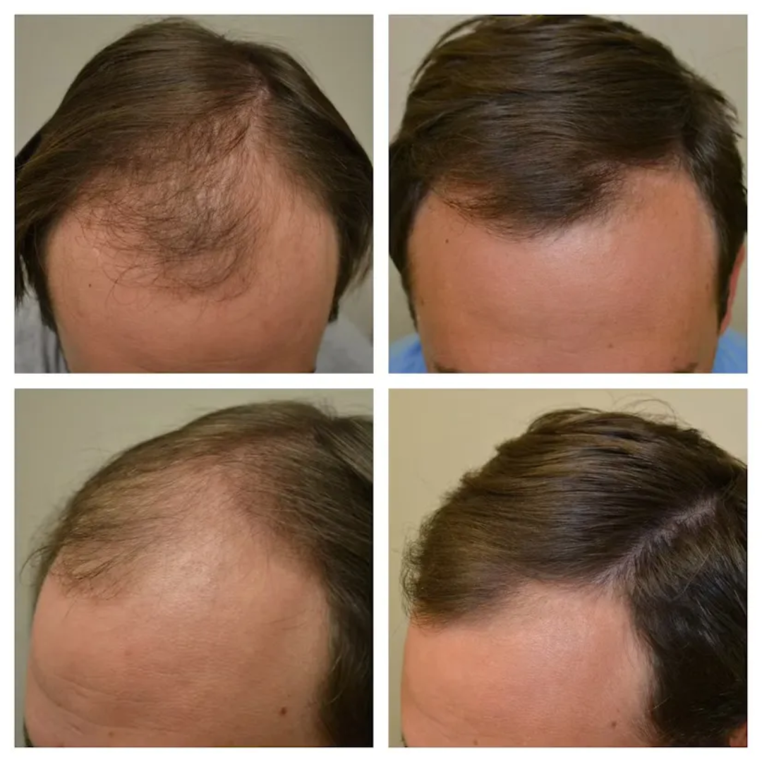 Proskire Hair Growth Serum – Reduces Hair Fall, Boosts Hair Density, Activates Follicles – For Bald Patches, Receding Hairline & Thinning Hair