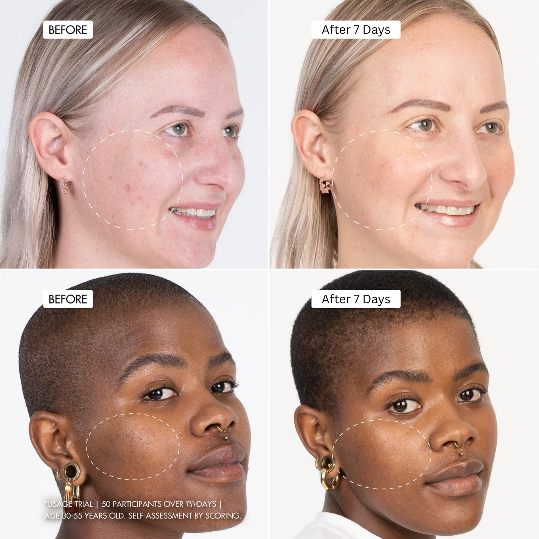 Arencia Holy Hyssop Serum - Remove Acne & dark sposts in 7 days