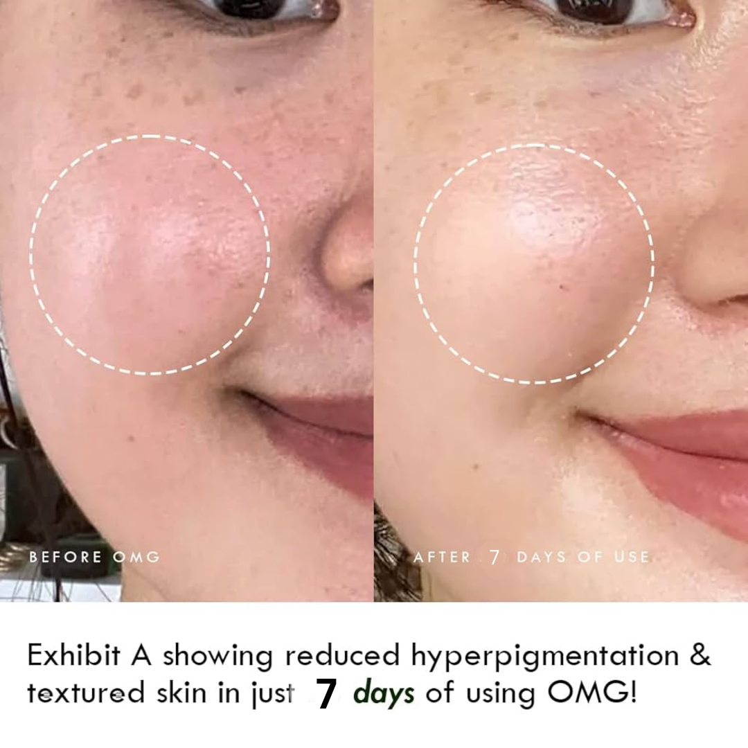 Arencia Holy Hyssop Serum - Remove Acne & dark sposts in 7 days