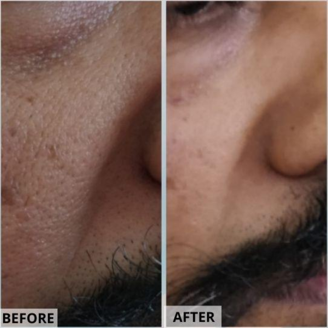 Dr. Melaxin Peel Shot PS Exfoliating Black Rice Ampoule | Removes Blackheads, Tightens Pores & Smooths Skin