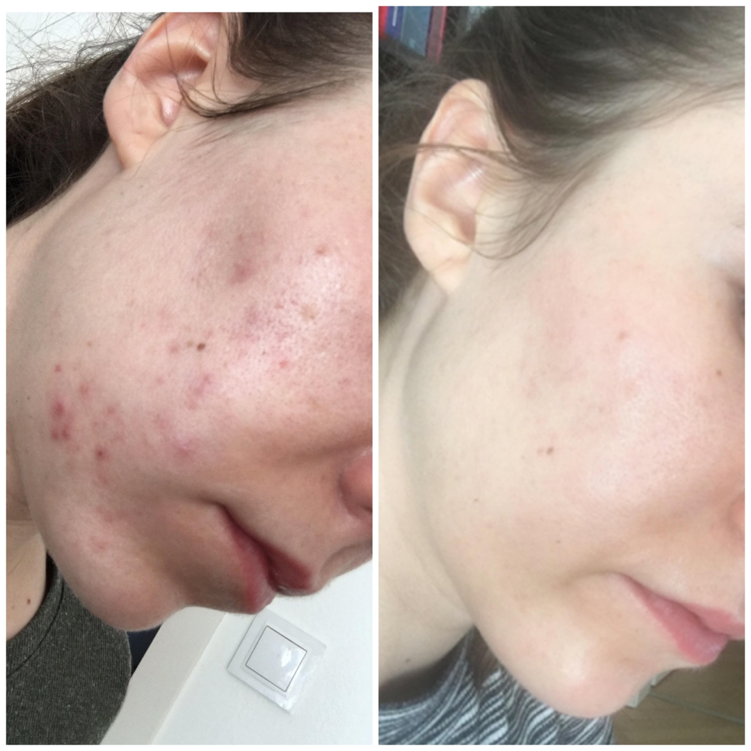 Celimax Noni Ampoule Calming + Radiance | Soothing Hydrating Serum for Healthy, Glowing Skin