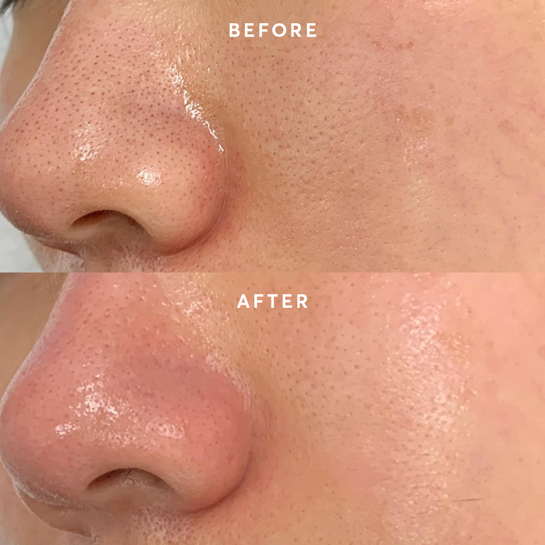 SKINTIFIC Alaska Volcano Pore Clay Stick | Glycolic Acid + Probiotic Complex + Collagen | Removes Blackheads, Tightens Pores & Smooths Skin