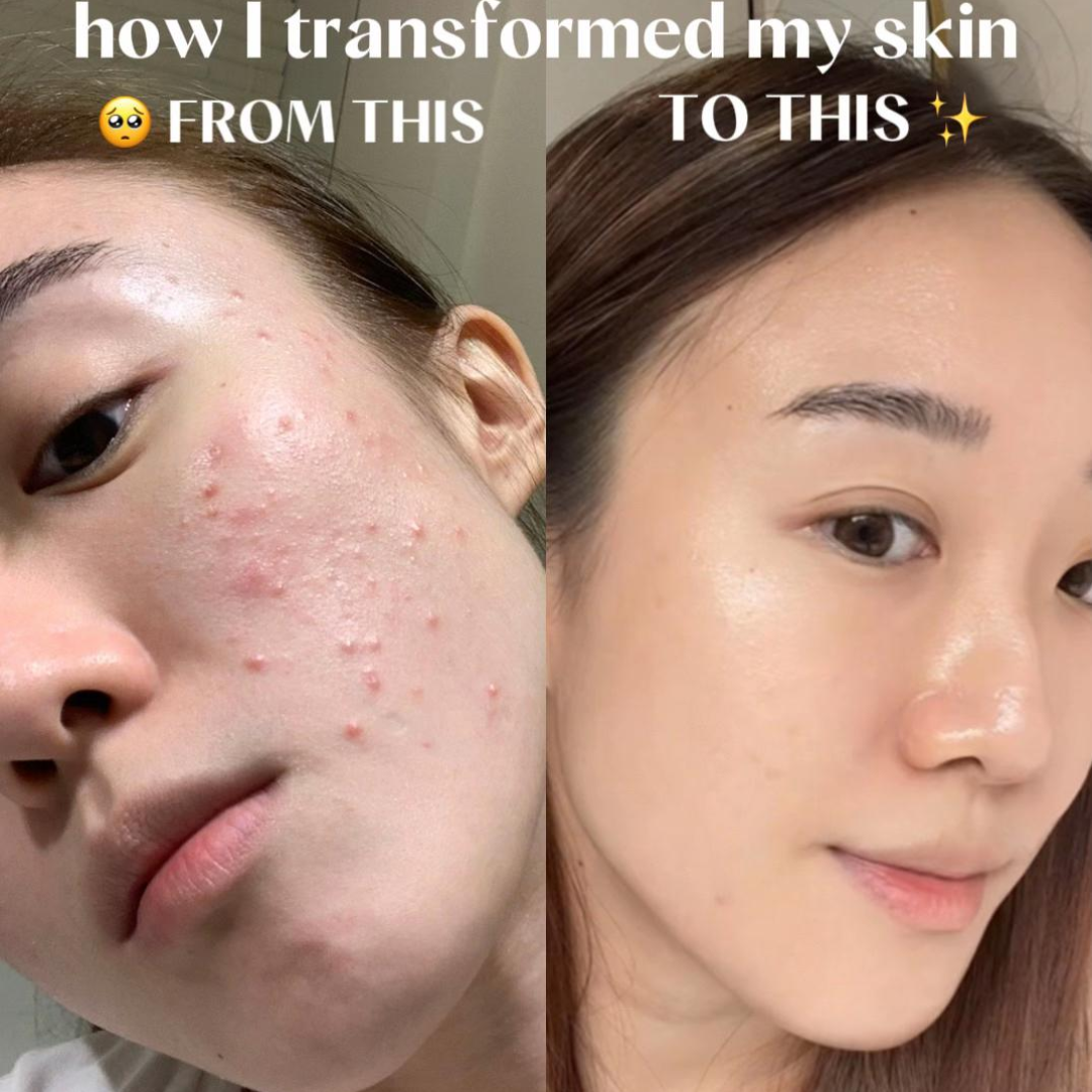 Dr. Melaxin Peel Shot PS Exfoliating Black Rice Ampoule | Removes Blackheads, Tightens Pores & Smooths Skin