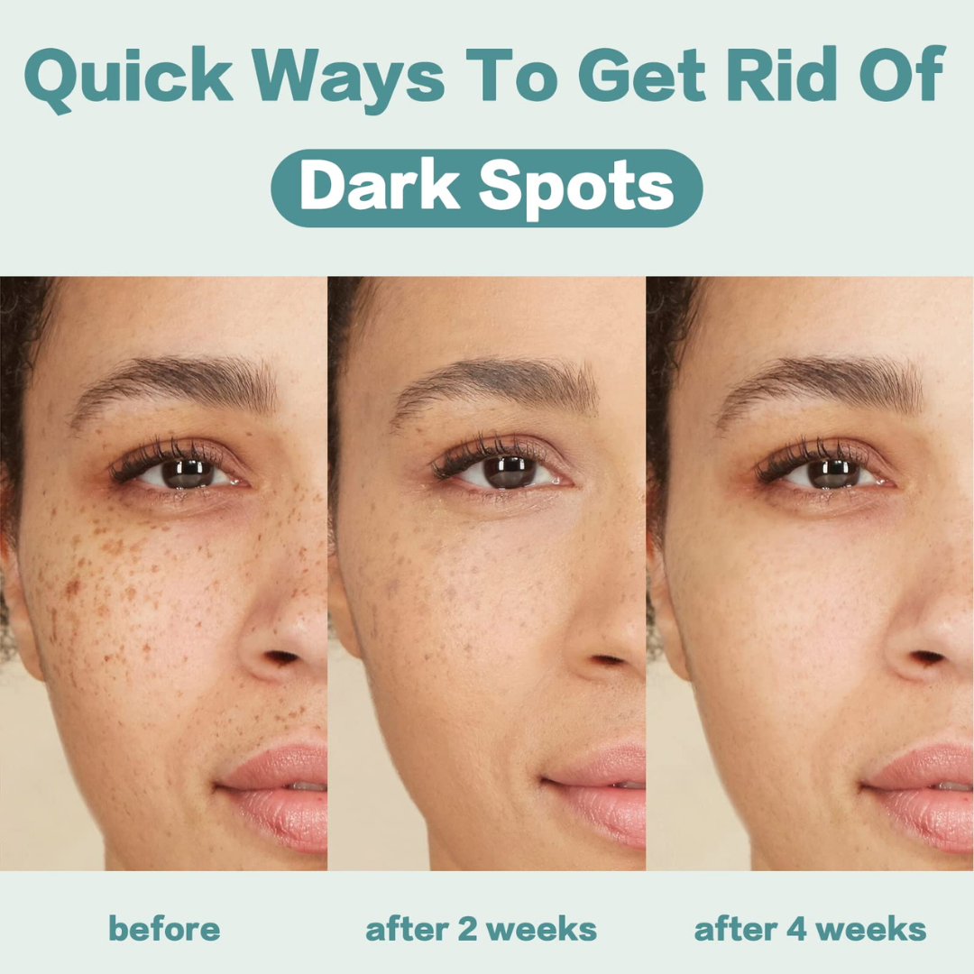 Dark Spot Corrector for Face – Fade Dark Spots Fast – Bright, Even Skin – Targets Sun Spots, Age Spots, Acne Marks & Freckle