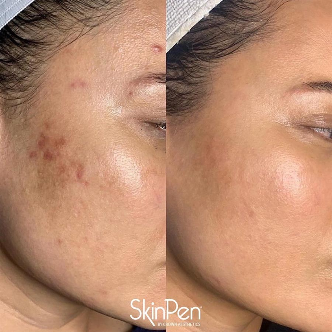 Dark Spot Corrector for Face – Fade Dark Spots Fast – Bright, Even Skin – Targets Sun Spots, Age Spots, Acne Marks & Freckle