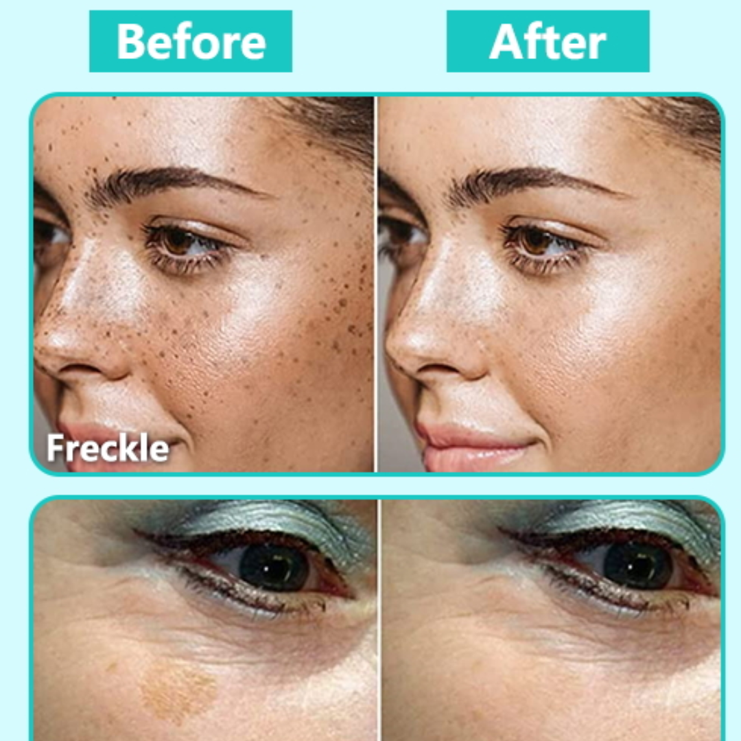 Dark Spot Corrector for Face – Fade Dark Spots Fast – Bright, Even Skin – Targets Sun Spots, Age Spots, Acne Marks & Freckle