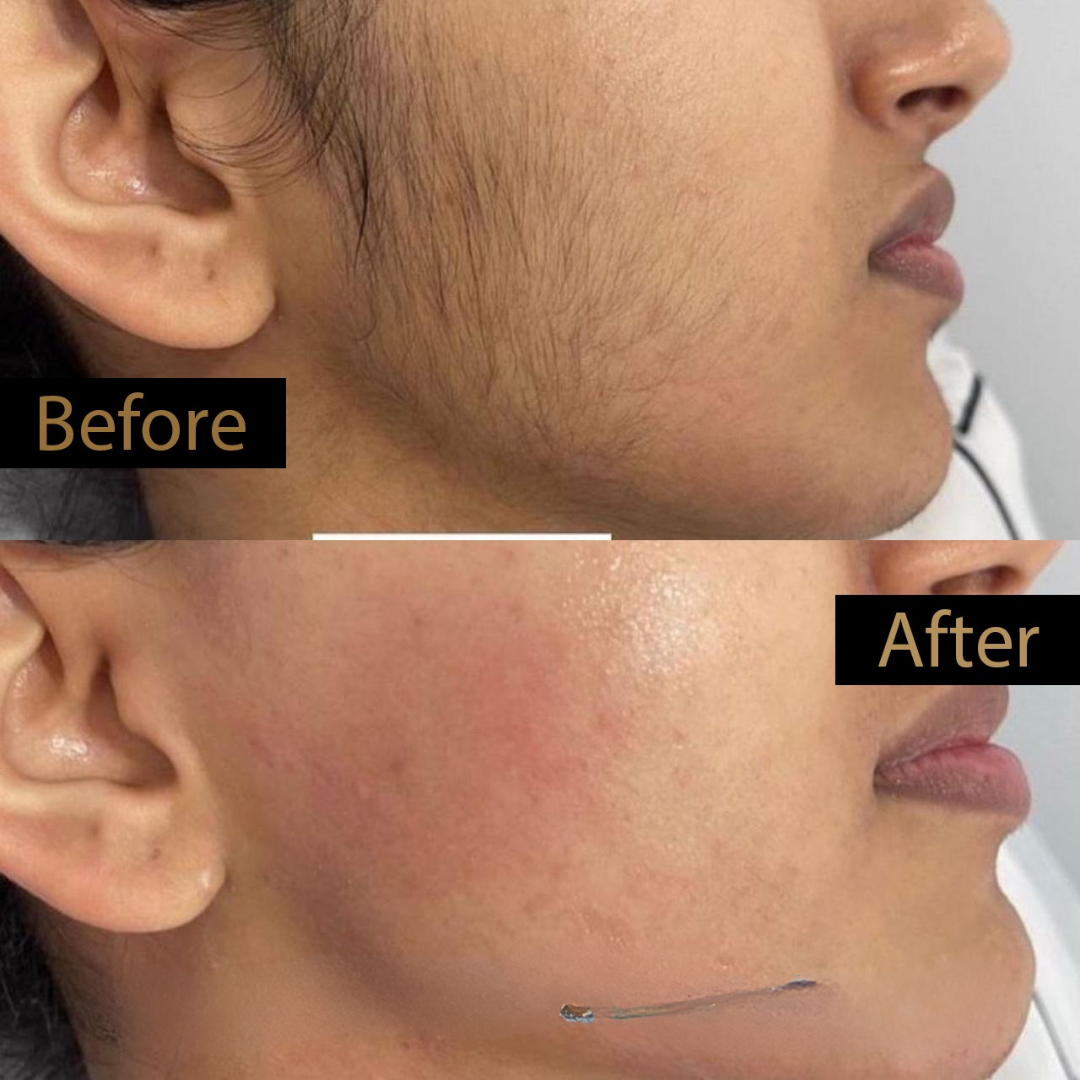 Urban Yog Electric Facial Hair Remover | Painless Peach Fuzz Remover for Sensitive Skin | Portable & Rechargeable