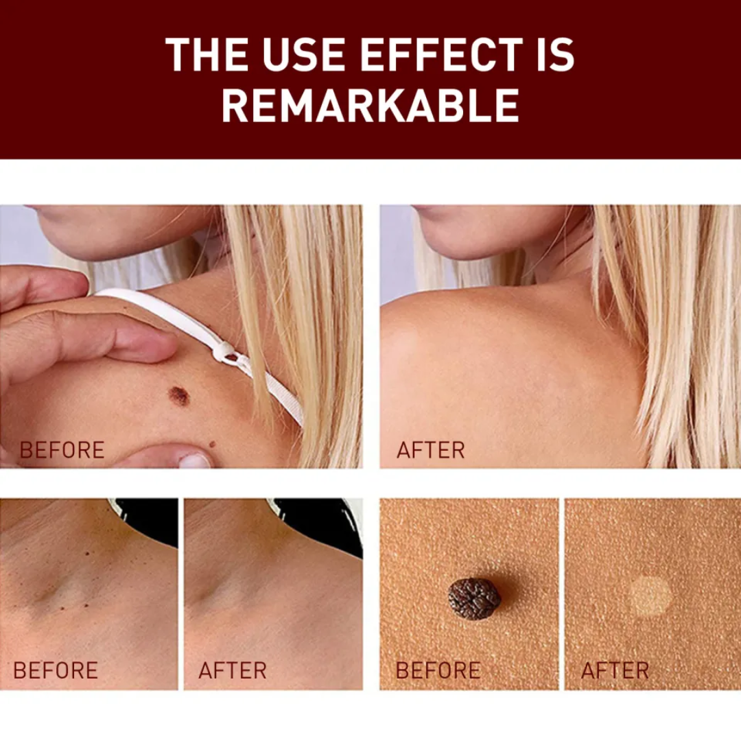 Acne & Acne Scars Removal Cream – Fast Acne Treatment, Fades Scars, Controls Oil & Bacteria – Suitable for Face, Back & Neck