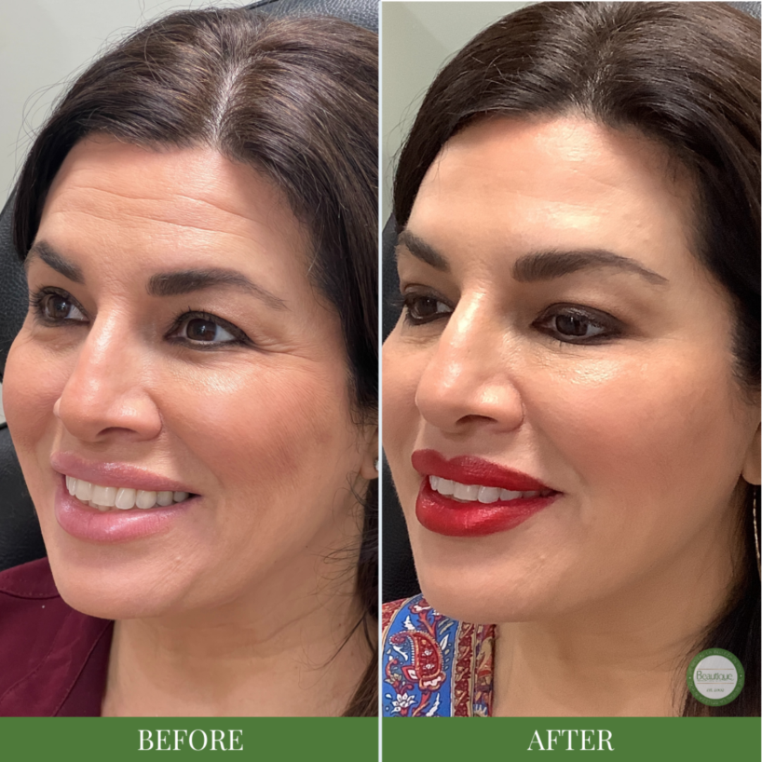 Anua PDRN + Hyaluronic Acid 100 Moisturizing Cream – Deep Hydration & Skin Plumping Cream for Glass Skin