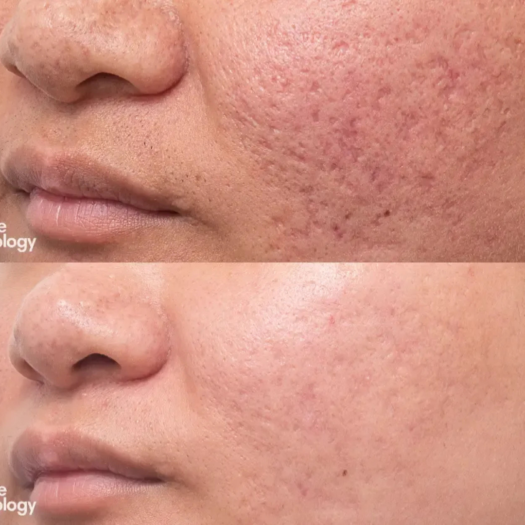 Acne & Acne Scars Removal Cream – Fast Acne Treatment, Fades Scars, Controls Oil & Bacteria – Suitable for Face, Back & Neck