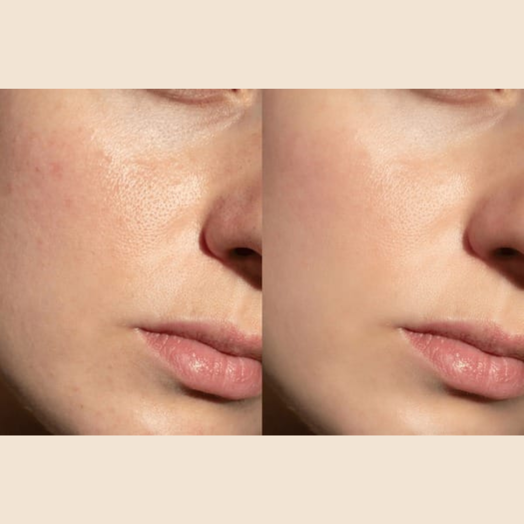 Reju-all PDRN Cream - Remove dark spots, blemishes, dry - patches & give glowing smooth & hydrated skin