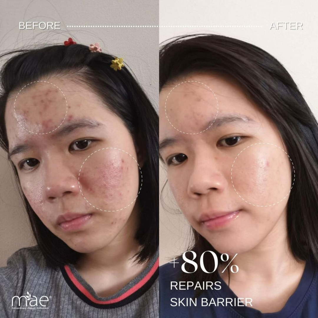 Acne & Acne Scars Removal Cream – Fast Acne Treatment, Fades Scars, Controls Oil & Bacteria – Suitable for Face, Back & Neck
