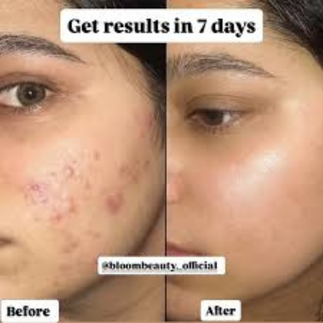 Acne & Acne Scars Removal Cream – Fast Acne Treatment, Fades Scars, Controls Oil & Bacteria – Suitable for Face, Back & Neck