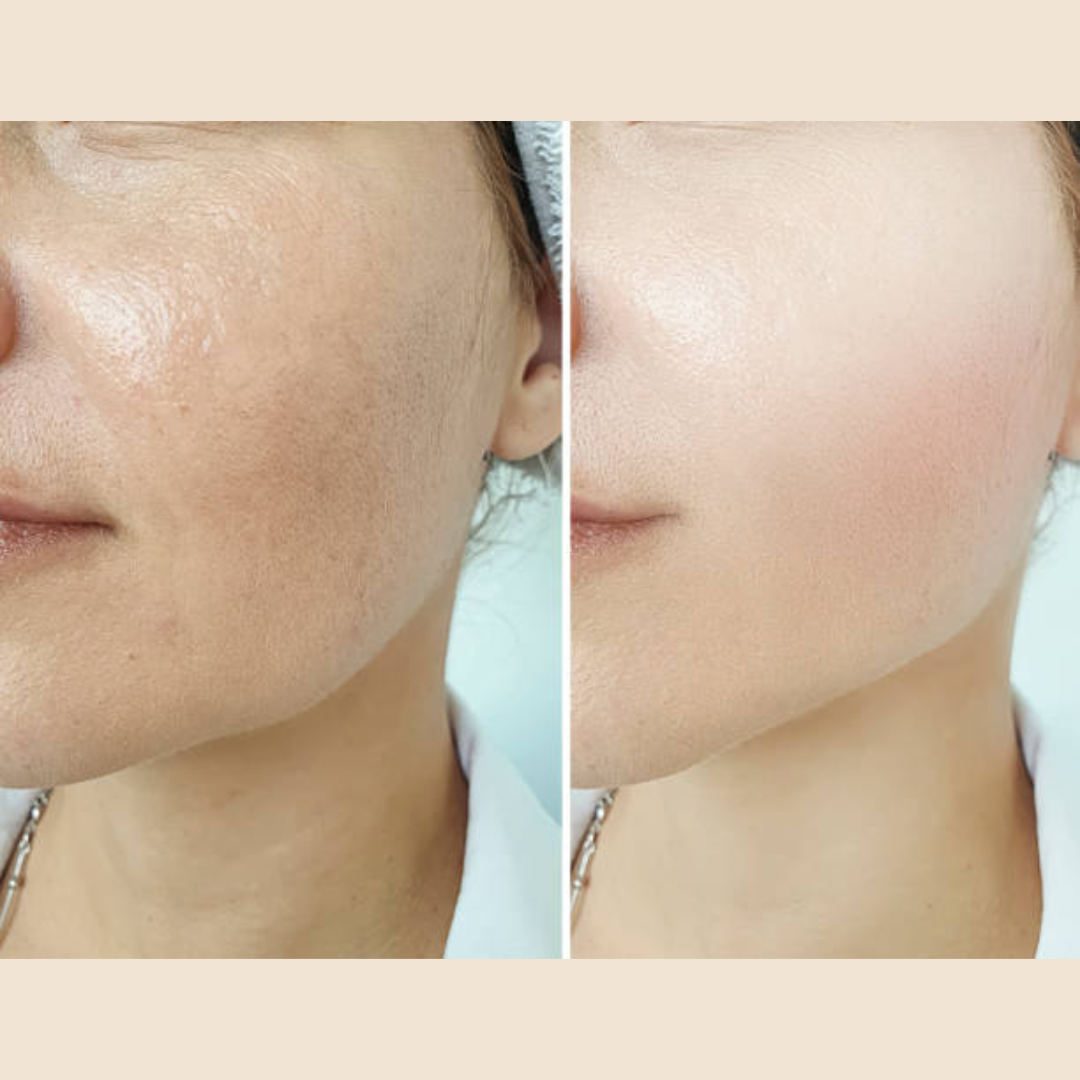 Reju-all PDRN Cream - Remove dark spots, blemishes, dry - patches & give glowing smooth & hydrated skin